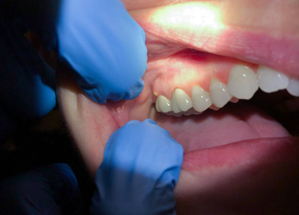 Best Broken or Cracked Tooth Emergency Dentist in Olivette, MO